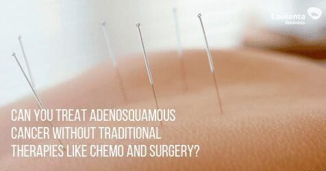 Can you treat adenosquamous cancer without chemo and surgery?