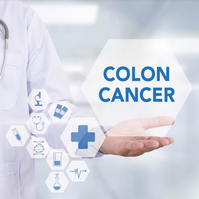 Overview of All Colon Cancer Stages and Symptoms