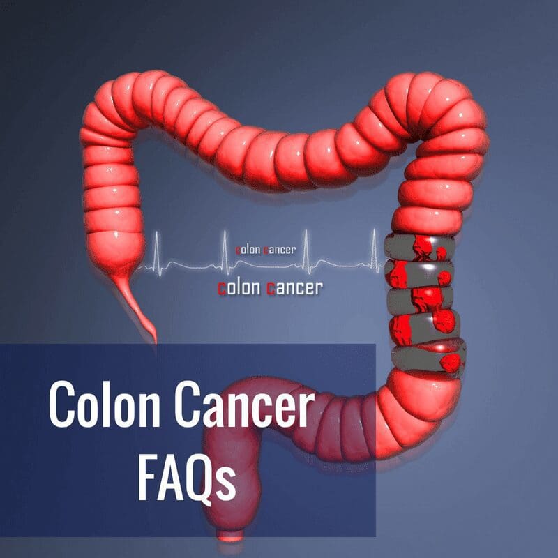 Colon Cancer FAQs