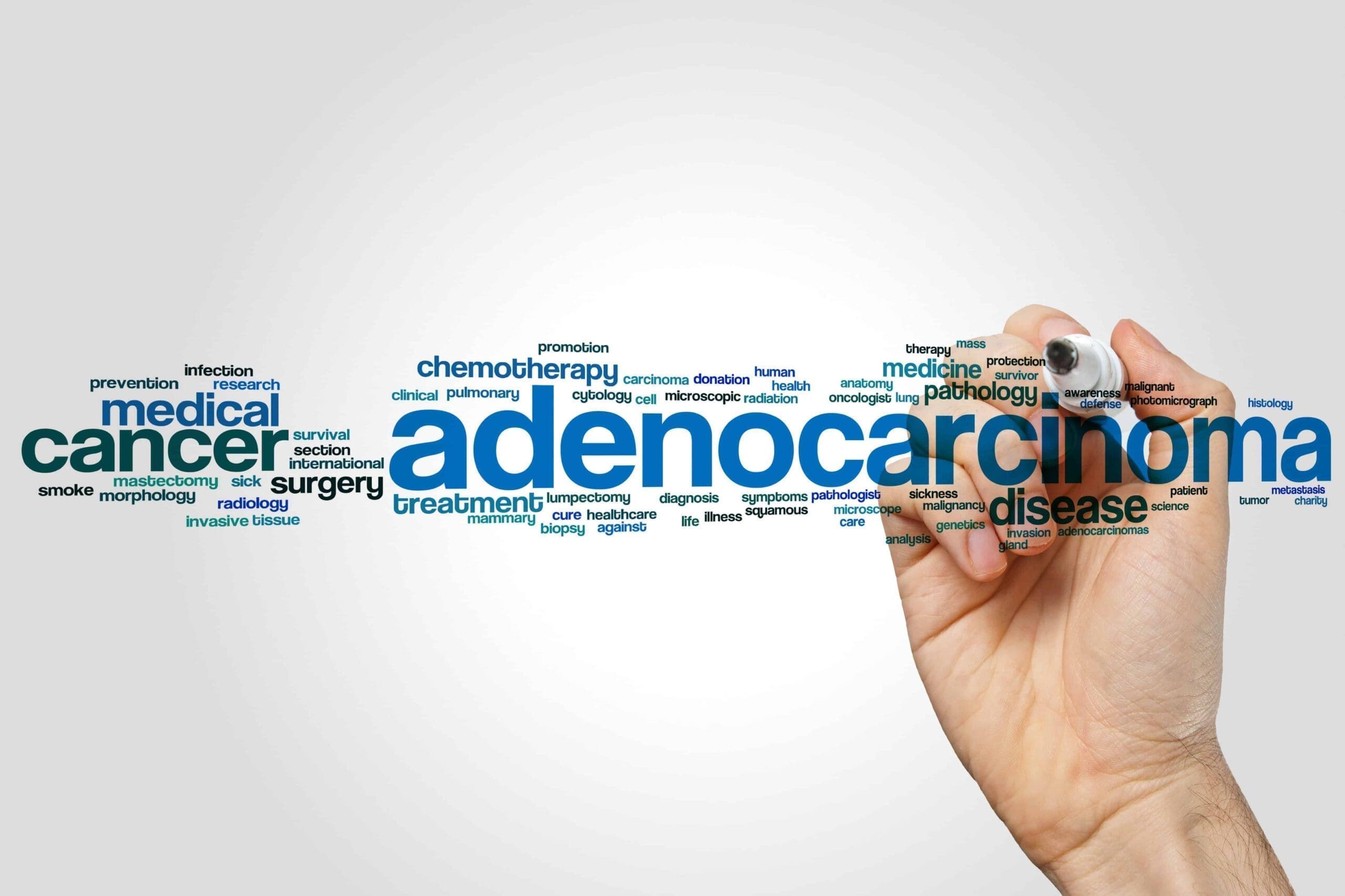 Everything you need to know about Adenocarcinoma: Get the Facts Right!