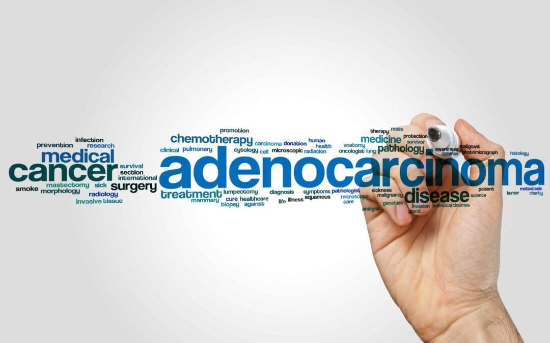 Everything you need to know about Adenocarcinoma: Get the Facts Right!
