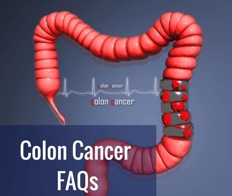 Colon Cancer FAQs