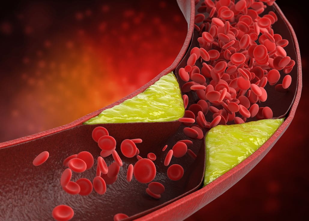 atherosclerosis with plaque in vessel Cancer Types We Treat